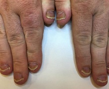 Редкая патология - псориаз ногтей. Пациент длительно и безуспешно лечил грибок ногтей.